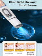 Quick and painless removal of warts, the latest generation blue light laser pen, hot-selling package