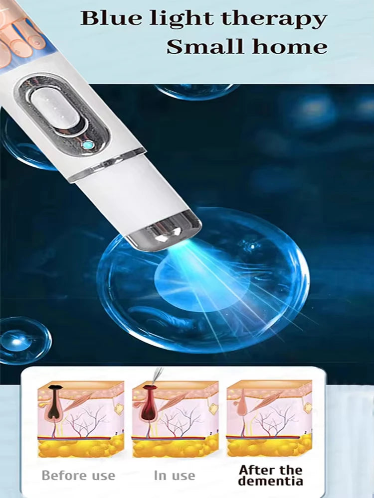 Quick and painless removal of warts, the latest generation blue light laser pen, hot-selling package
