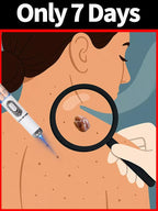 Quick and painless removal of warts, the latest generation blue light laser pen, hot-selling package