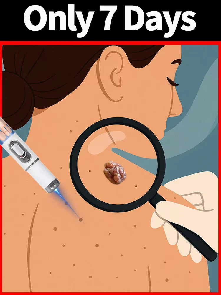 Quick and painless removal of warts, the latest generation blue light laser pen, hot-selling package